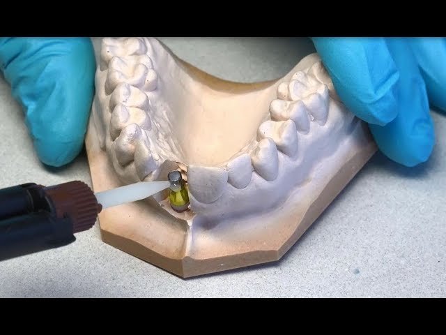 Dental Implant Costs in Miami 