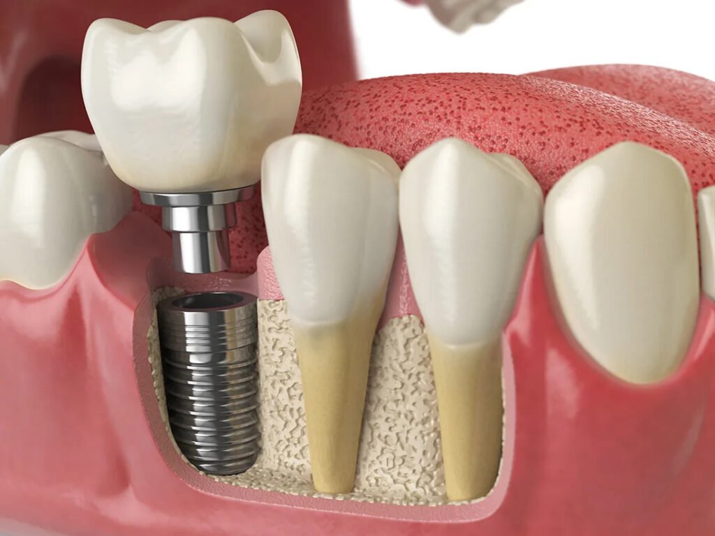 How Much Does a Front Tooth Implant Cost in 2025?