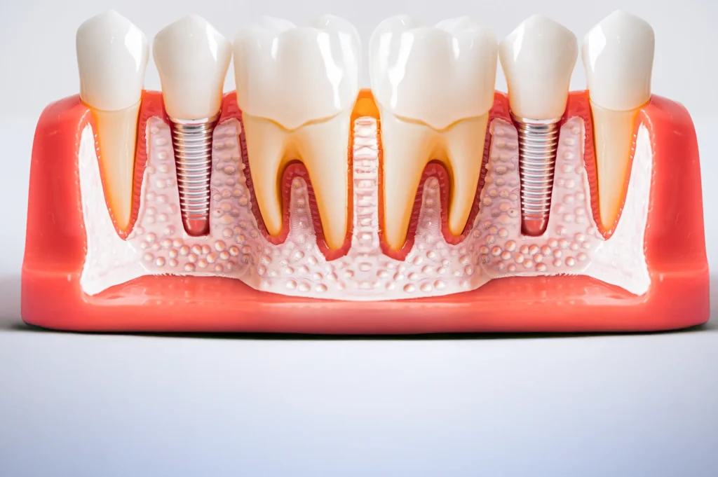What is the Cost of a Dental Implant Tooth in 2025?