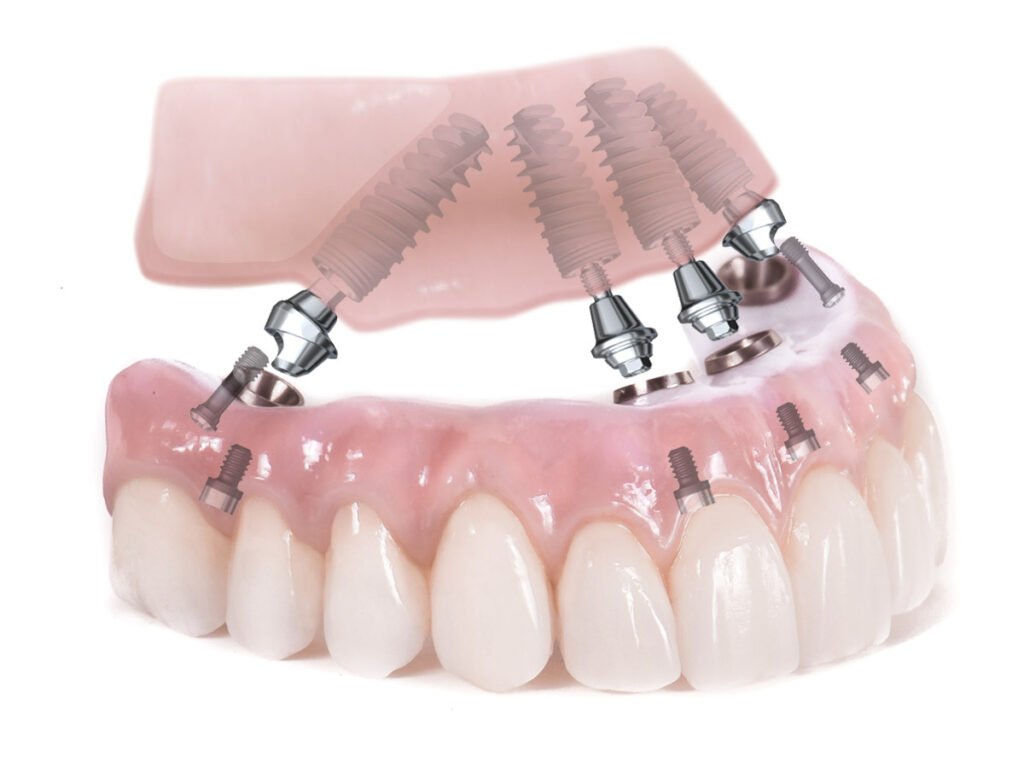 Unlocking Your Best Smile: Your 2025 Guide to All-on-4 Dental Implants Cost Near Me