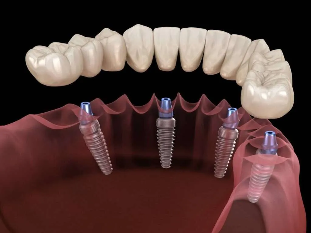 Costo de Implantes Dentales in 2025