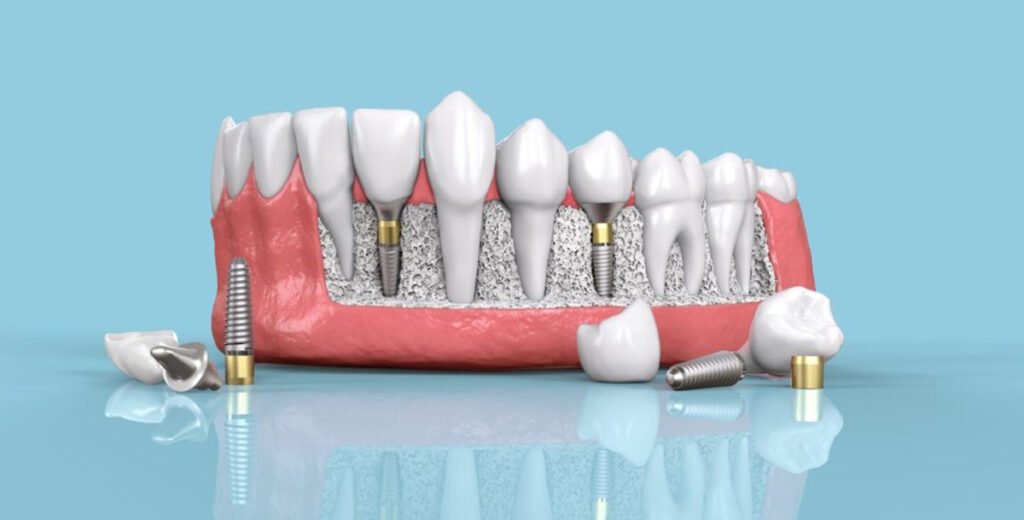 Single Tooth Dental Implant Costs 