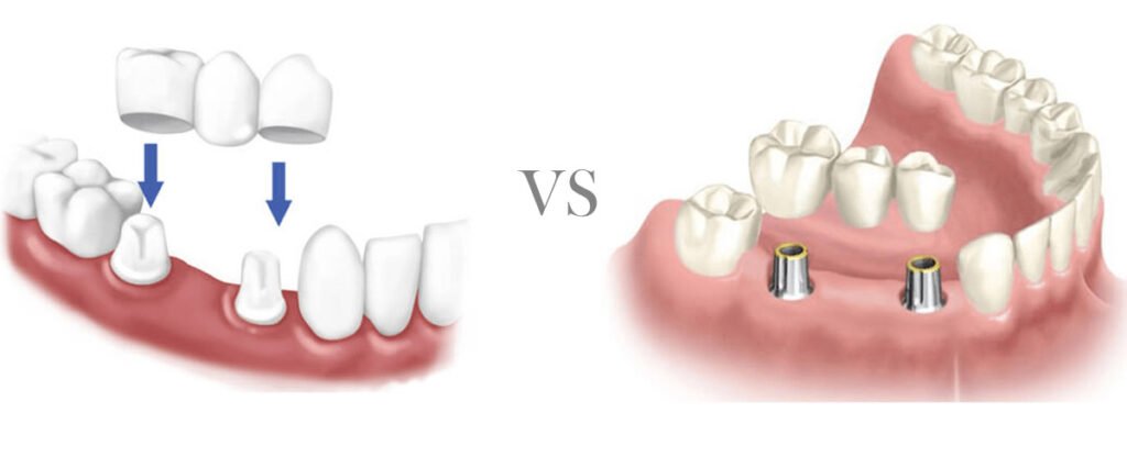 Dental Implant Versus Bridge Cost