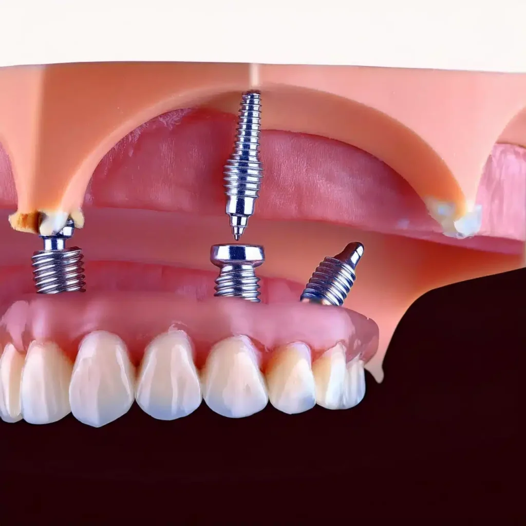 Cost of All-on-4 Dental Implants in 2025