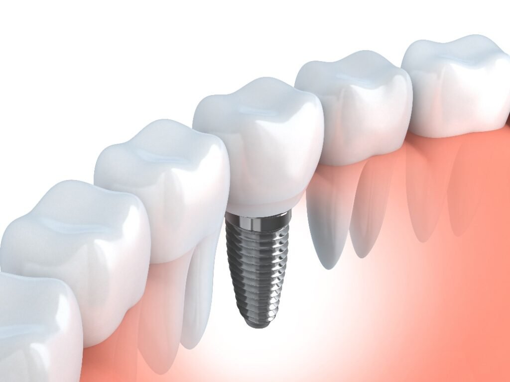 Mini Dental Implants at Aspen Dental