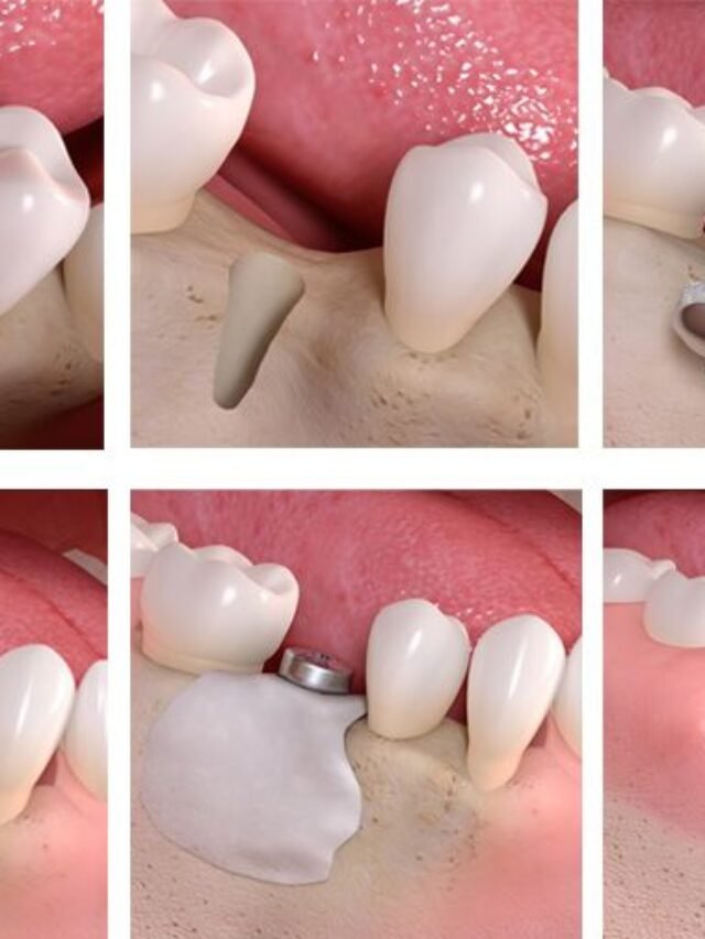 Bone.graft