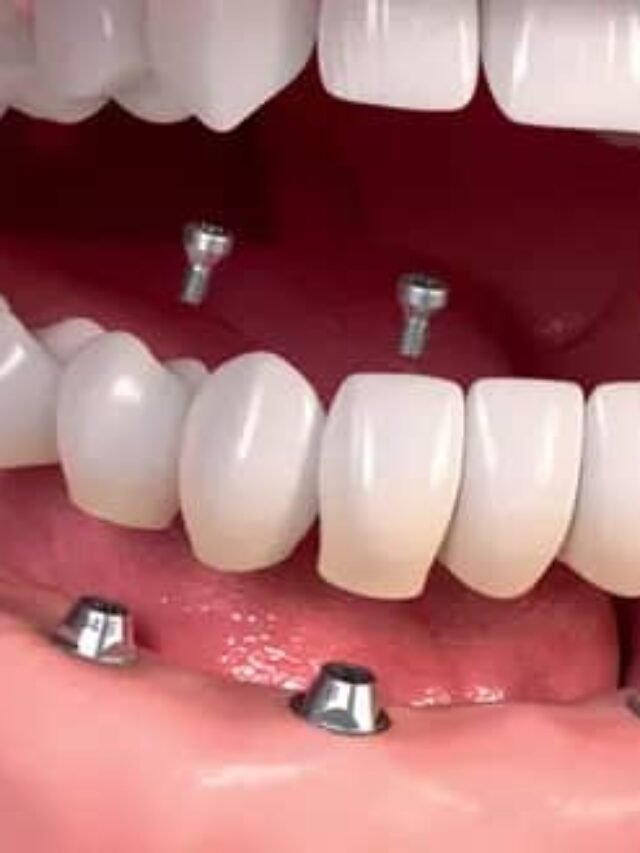 Getting dental implants can be a life-changing decision, offering a durable and aesthetically pleasing solution for missing teeth.