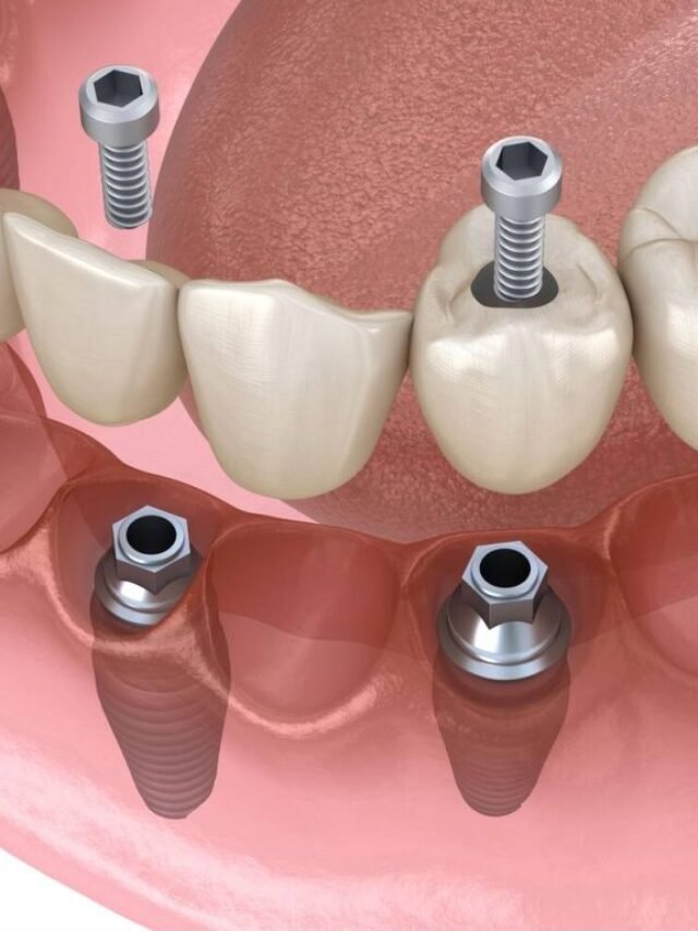 all-on-four-implants-cost-1024x768