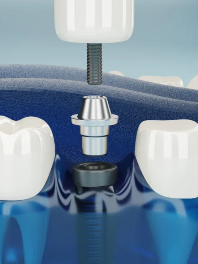 How Much for One Tooth Implant in 2025?