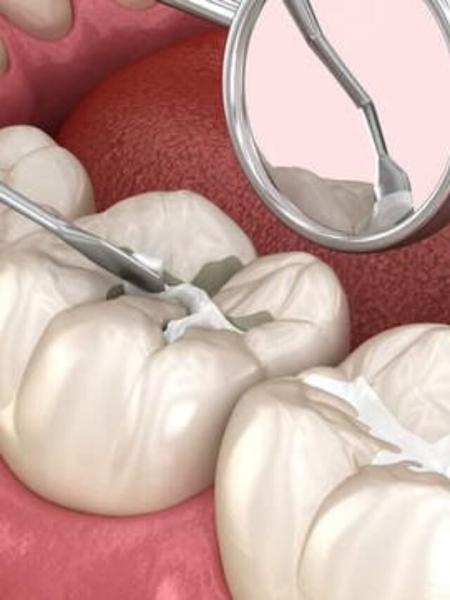 dentists-attr-composite-tooth-filling-hos2070-2-250