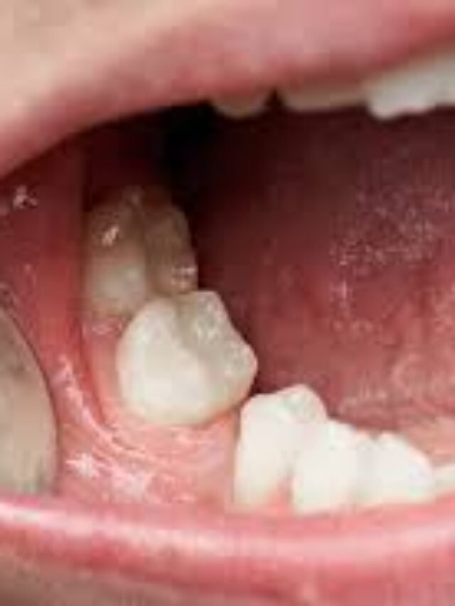 https://dallasdentalimplantcost.com/how-much-does-a-dental-implant-molar-cost/