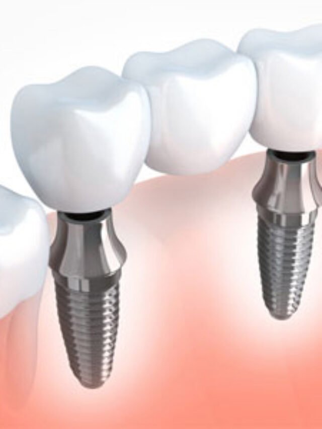 implant-in (1)