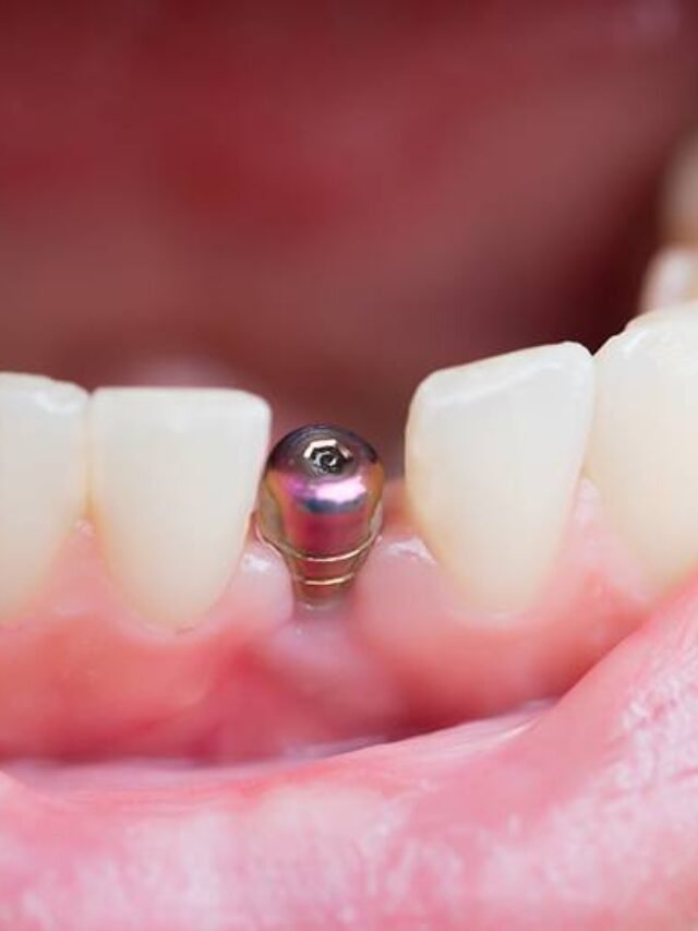 implant-salvage-1