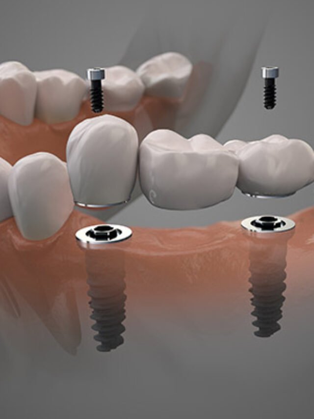 https://dallasdentalimplantcost.com/cost-of-2-dental-implants-in-2025/
