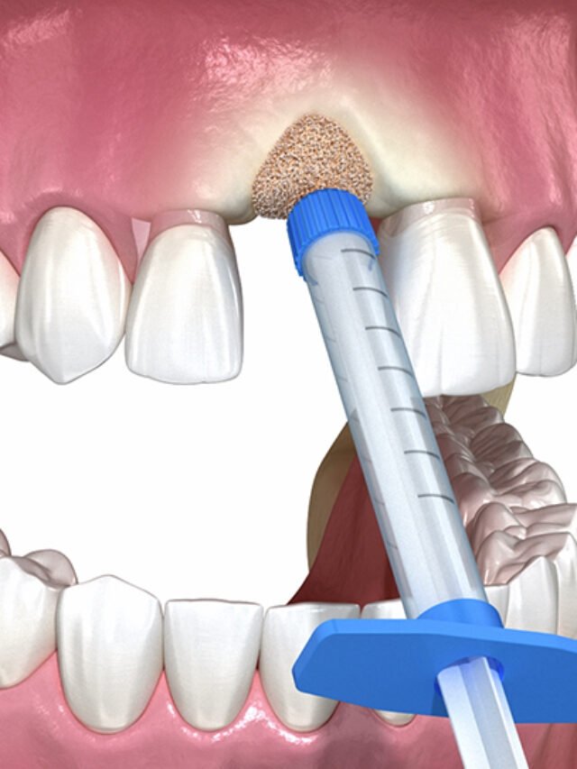 luwi-dental-bone-graft