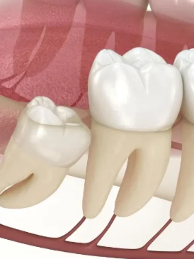 wisdom-teeth-illustration-e1747160020373