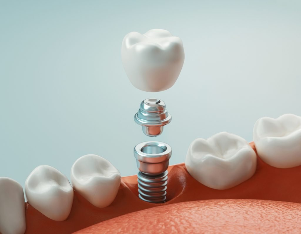 Cost of Dental Implants in 2025