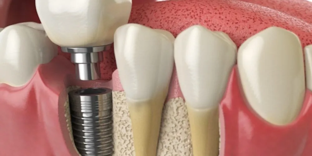 Cost of Upper Dental Implants in 2025