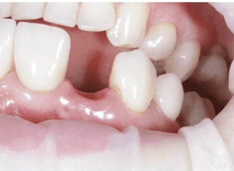 How Much Does a Dental Implant Molar Cost in 2025?