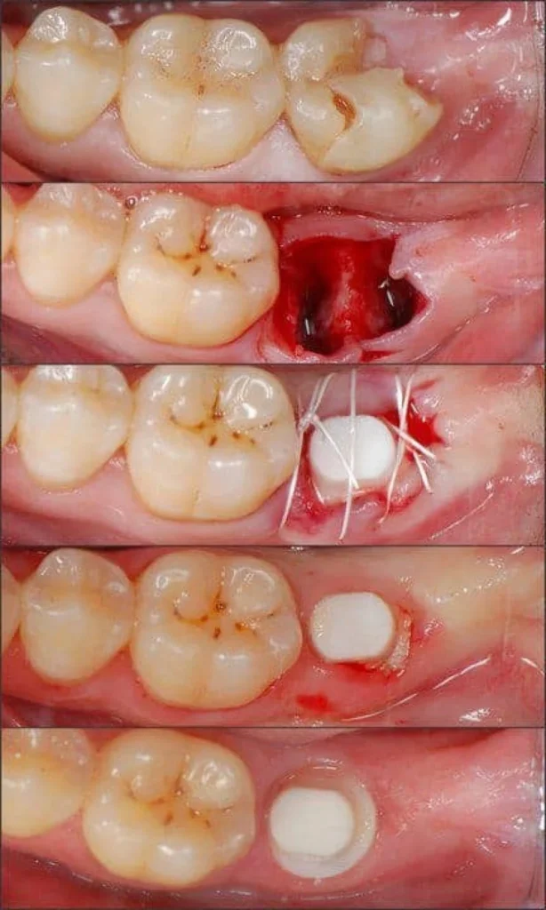 Dental Implant Pain