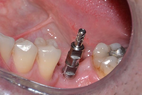 Cost of 4 Dental Implants in 2025