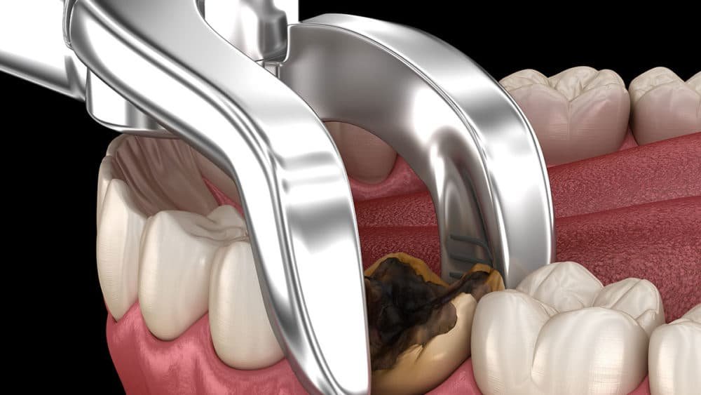 How Much Does a Wisdom Tooth Extraction Really Cost